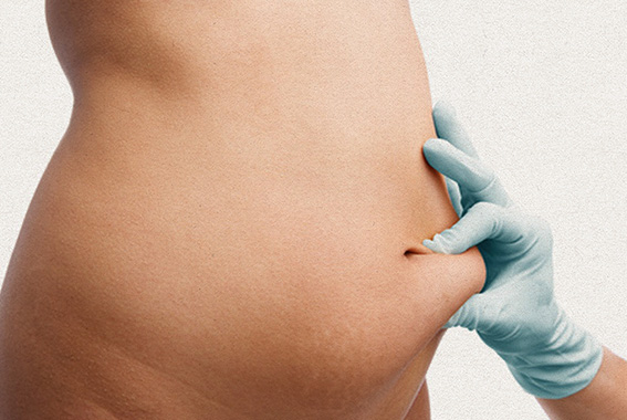 Abdominoplastia Dr. Rodrigo Pimenta - Fortaleza