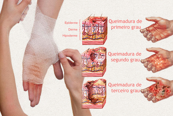 Graus (profundidade) de uma queimadura - Dr. Rodrigo Pimenta