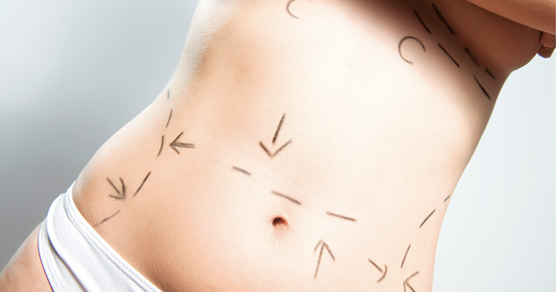 Abdominoplastia | Dr. Rodrigo Pimenta